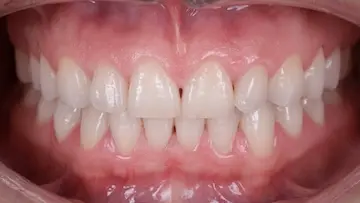 Soins dentaires courants